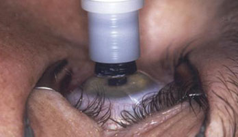 Ophtha_Microkeratome